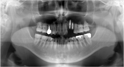 川畑4(1)　埋入時